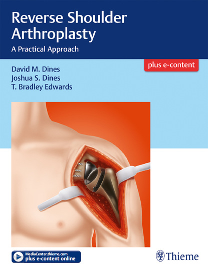 David M. Dines - Reverse Shoulder Arthroplasty